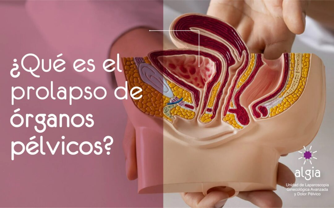¿Qué es el prolapso de órganos pélvicos?